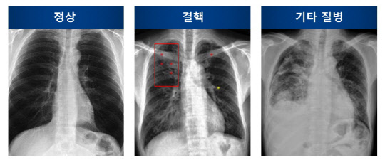 'DxRAD'로 흉부 엑스레이 영상을 판독한 이미지. 왼쪽부터 정상, 결핵, 기타질병.  메디칼이노베이션디벨로퍼 제공